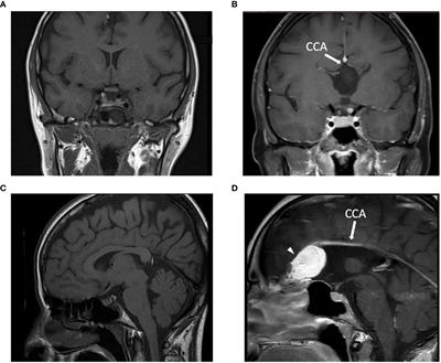 Case report: Twice-daily tolvaptan dosing regimen in a challenging case of hyponatremia due to SIAD